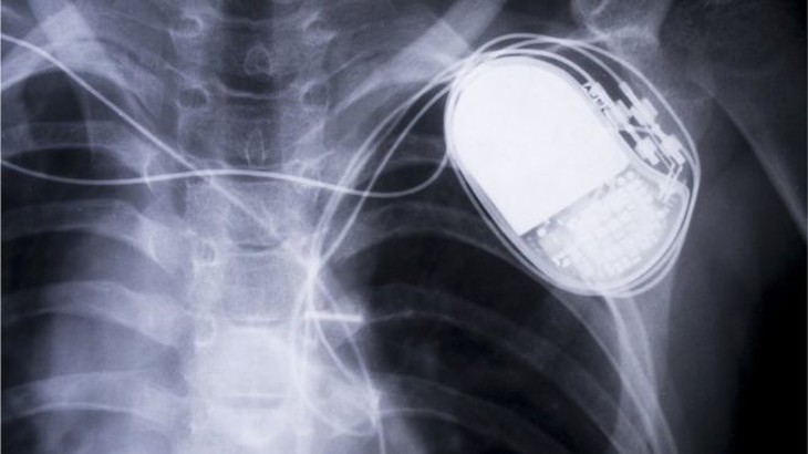 745.000 thiết bị máy điều hòa nhịp tim của Abbott có thể bị hack - Ảnh 1.